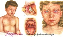 Улаанбурхан өвчлөлтэй холбоотой мэдээлэл